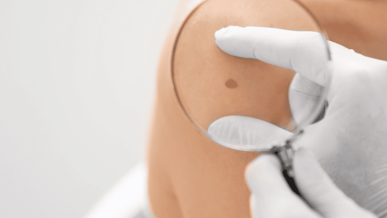 A person with a magnifying glass looking at a mole on an arm